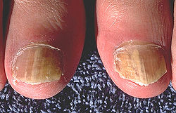 250px-Onychomycosis_due_to_Trychophyton_rubrum,_right_and_left_great_toe_PHIL_579_lores